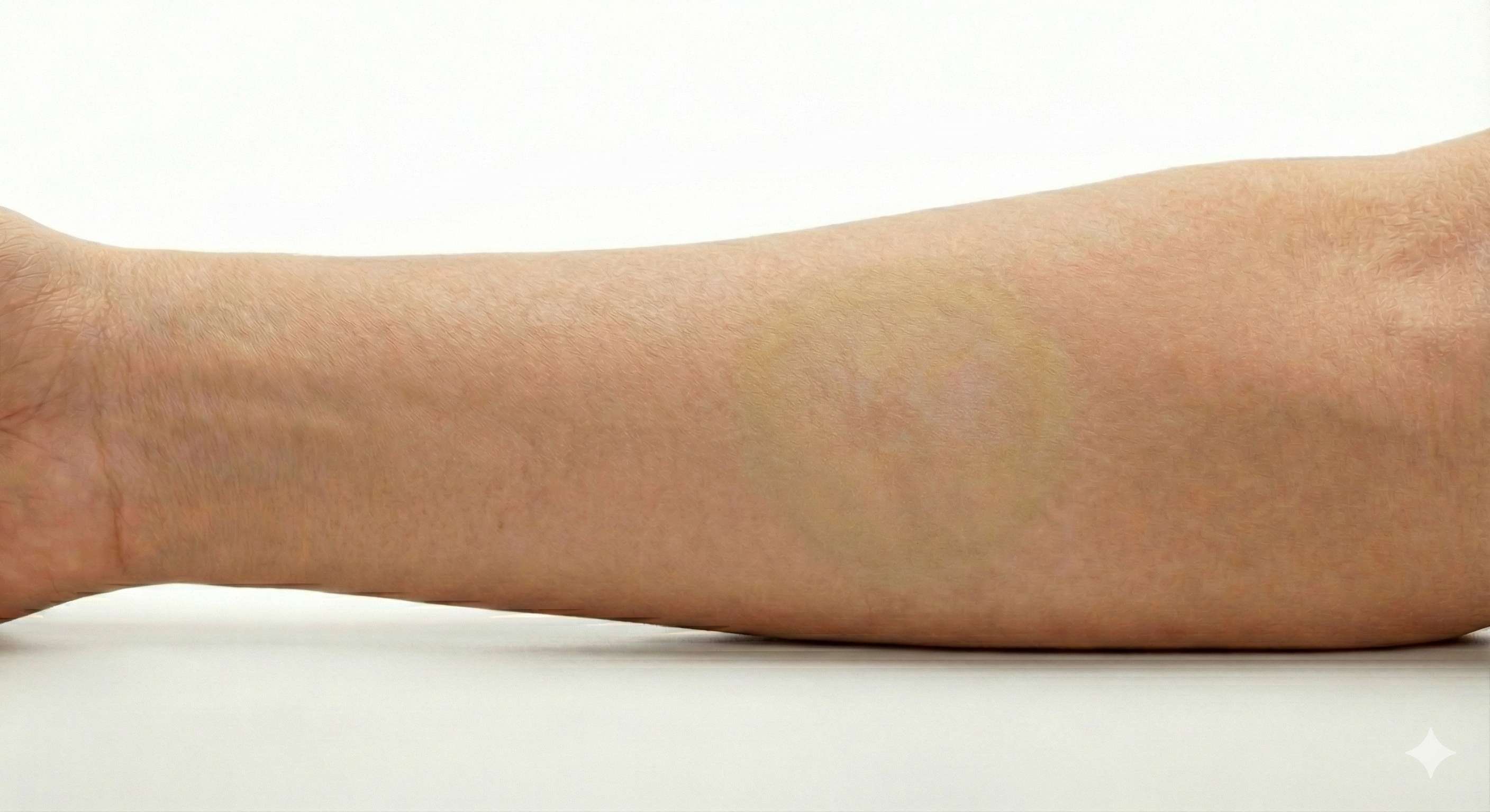 Bruise after 4 days of Unmark treatment - almost completely healed